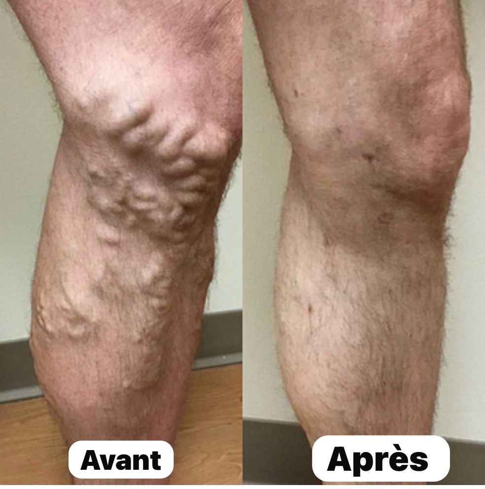 Krauter – Spray Naturel Anti-Varices I Des jambes plus saines, plus belles, plus légères.