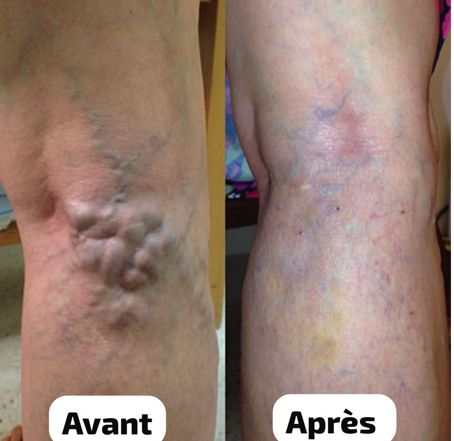 Krauter – Spray Naturel Anti-Varices I Des jambes plus saines, plus belles, plus légères.