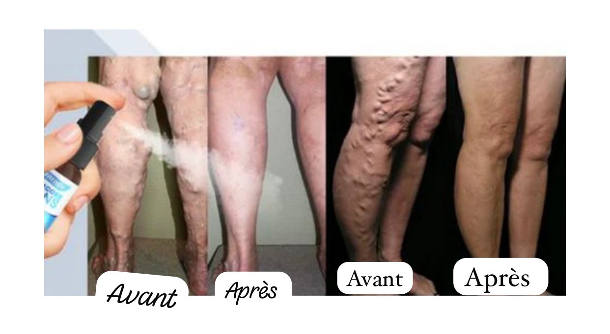 Krauter – Spray Naturel Anti-Varices I Des jambes plus saines, plus belles, plus légères.